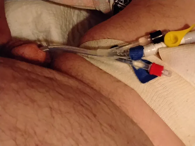 Late night addition. 18Fr trucath duo by Known_Western7525