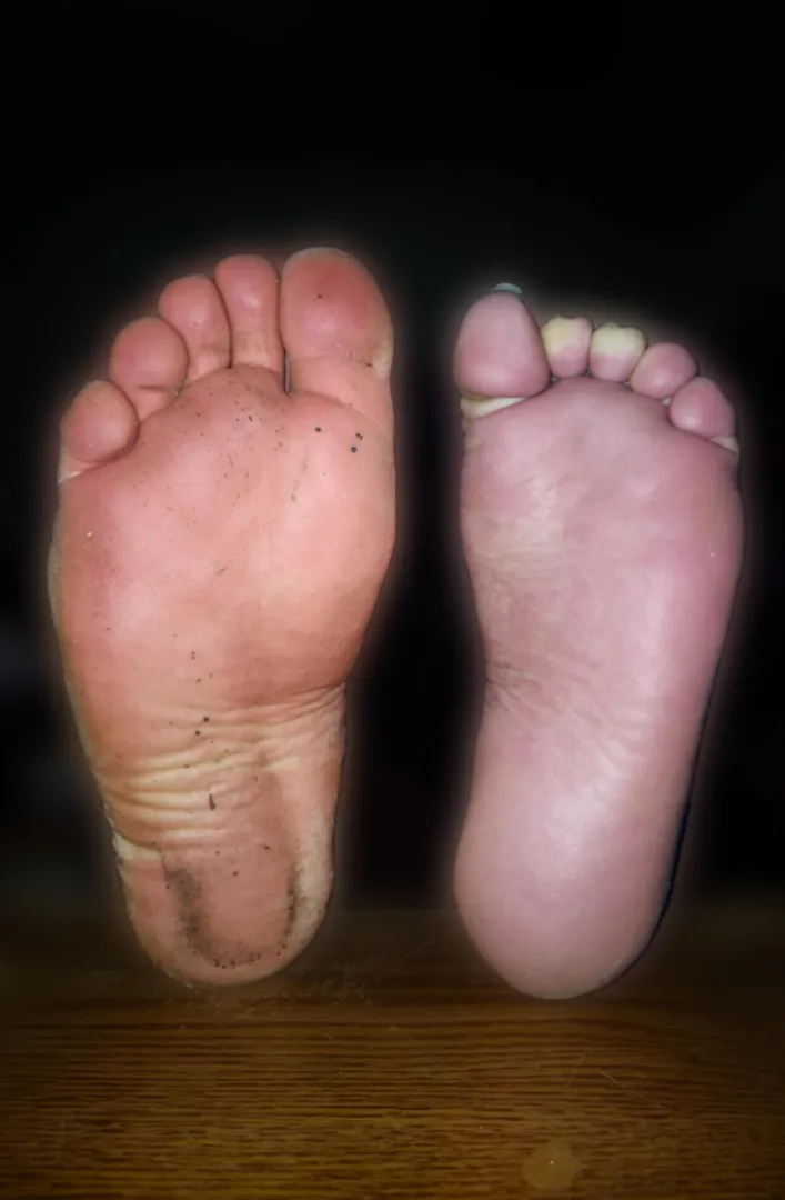Love wearing sandals on my healthy foot but its always getting dirty :/ posted by Elegant-Morning-8580