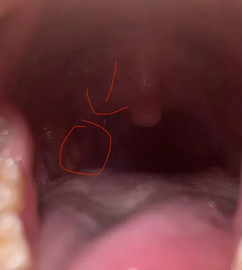 Lump near right tonsil flap idk what’s going on I’m scared ! Help by LolaM8193