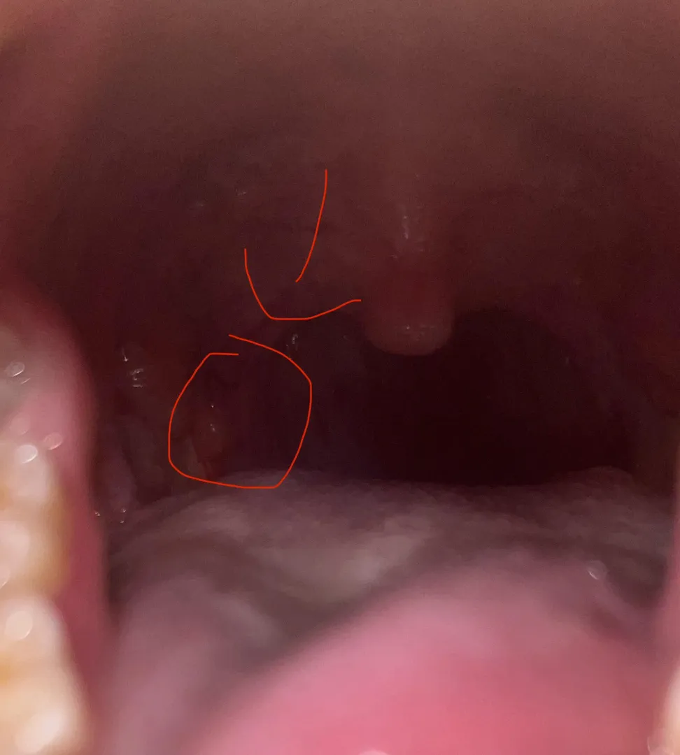 Lump near right tonsil flap idk what’s going on I’m scared ! Help posted by LolaM8193