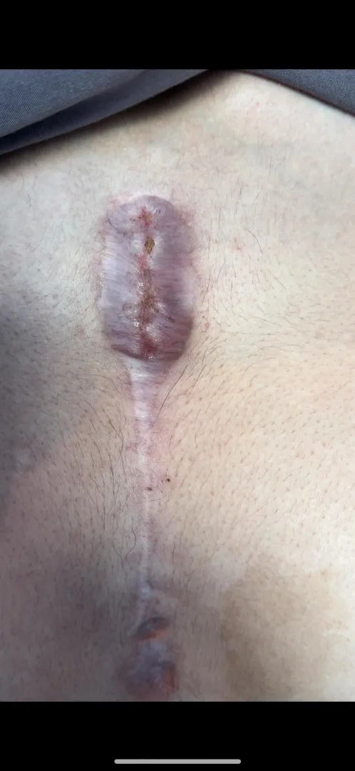 M25 Recurrent sternal wound dehiscence after multiple revisions and pectoral advancement (no clear cause despite extensive workup) posted by Virtual_Point_2430