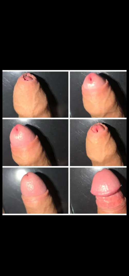 My experience with phimosis by Glad-Presence6060