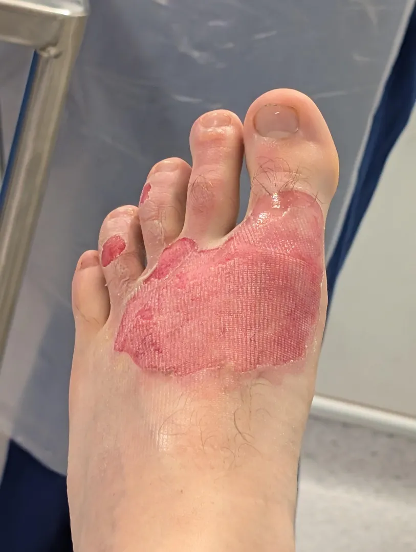 My new accident with boiling pasta posted by T3Quilla