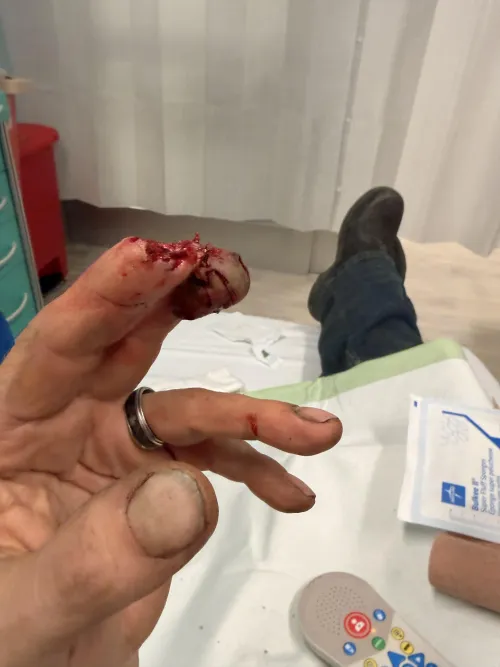 My partner’s coworker cut his fingertip off by Discokitty14