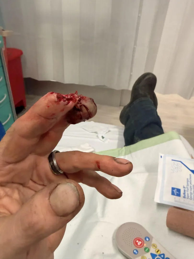 My partner’s coworker cut his fingertip off posted by Discokitty14
