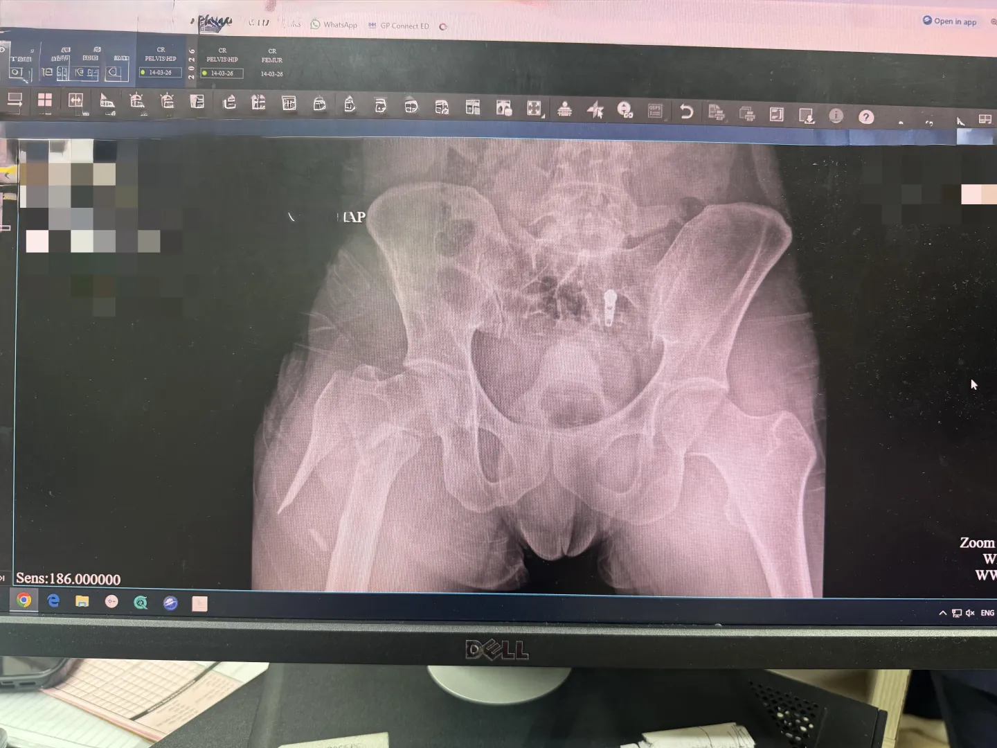 My right femur after slipping on wet floor at home. posted by comedycord