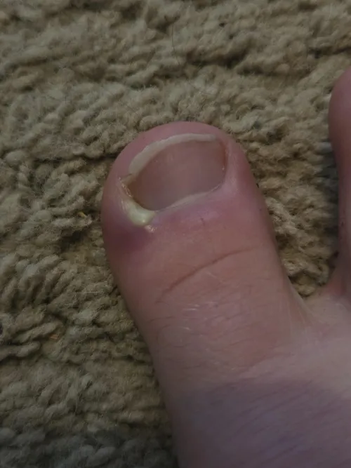 My toe has hurt the last day or so, this is what it looks like. What seems to be the issue here and what is my course of action? by DisastrousRope2565