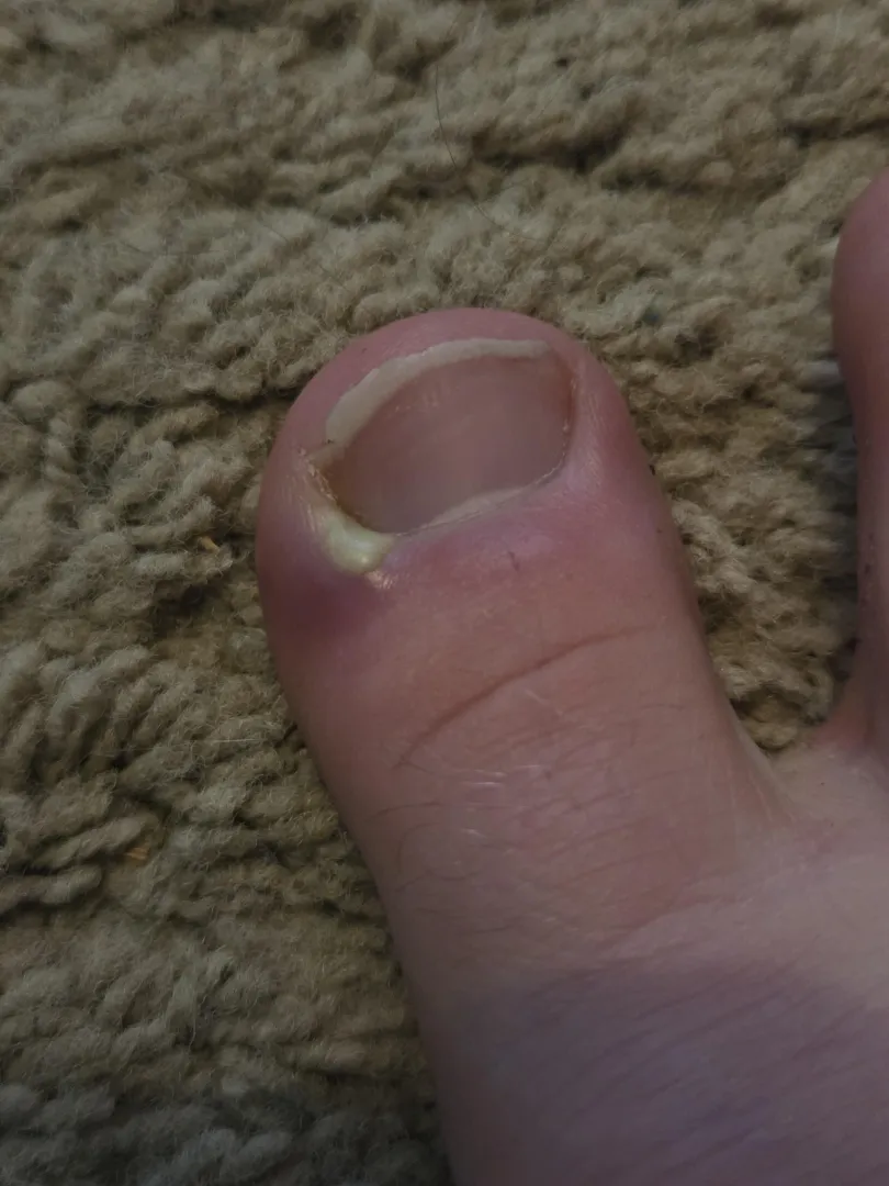 My toe has hurt the last day or so, this is what it looks like. What seems to be the issue here and what is my course of action? posted by DisastrousRope2565