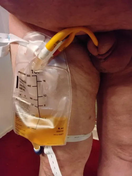 New catheter- installed at the urologist office. by Known_Western7525