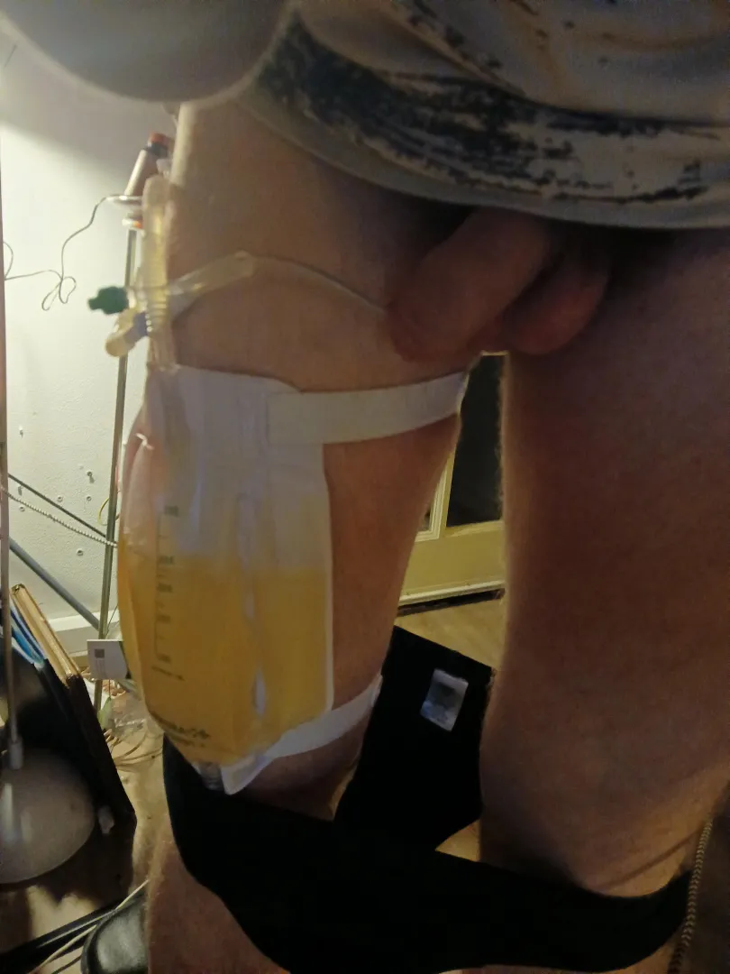 Now it wil not go as planned the doctor was trying today of i can pee on my one without a catheter is goes horribly wrong and now I have a new one inserted en must go to the uroloog in the hospital posted by baak20001