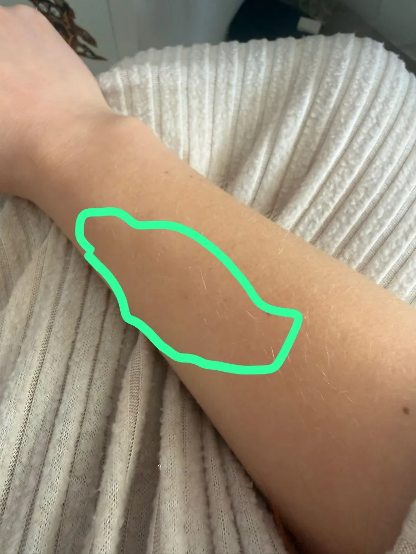 Numbness on forearm skin. I woke up yesterday with skin in the area numb, feels like pins and needles. posted by Rich-Sell-4625