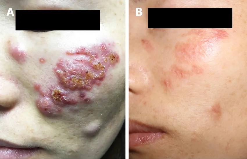 Patient got an injection to the face of hyaluronic acid fillers. The result was a granuloma. They treated the granuloma but patient was left scarred. posted by CatPooedInMyShoe