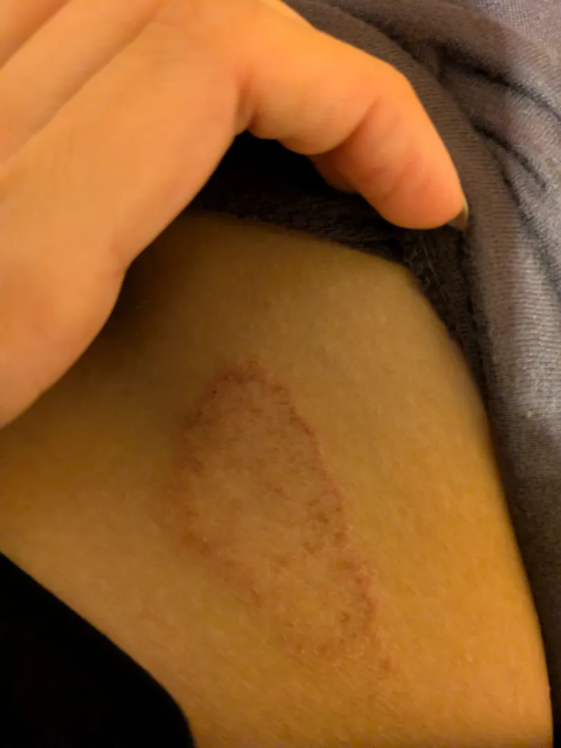 Persistent itchy patch on partner's hip (F) Getting worse over 8 weeks. Doesn't feel like her usual eczema. Any ideas? posted by TheBuzzer4625kHz