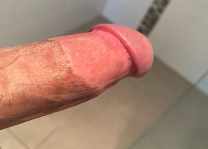 Proud every time I look down and see my crazy tight circumcision scar from when I let someone cut all of my foreskin and frenulum off! by jonsmith93