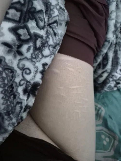 Pully my pants down to show you my scars by saraonly420