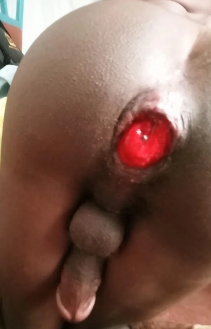 Pushing for a fully bloomed prolapse. posted by CartoonistFar1799