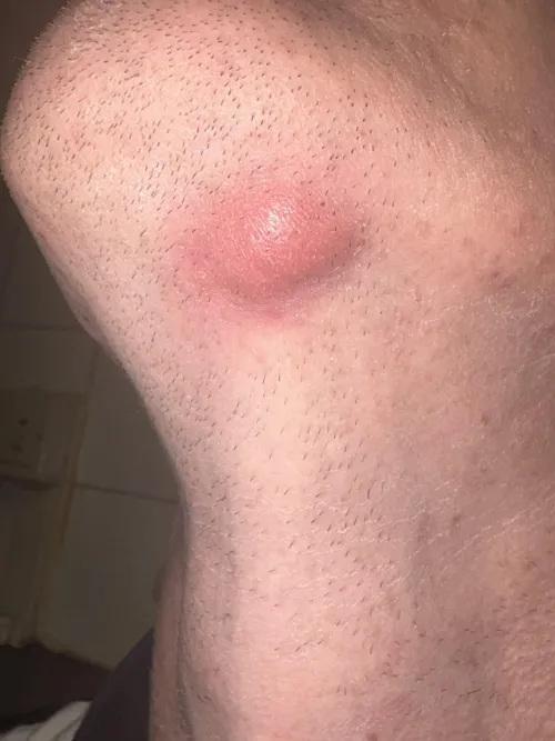 Red lump under my chin around 2-3 cm in size. No head or mark indicating a bite or a boil/spot. by EggplantCorrect2456