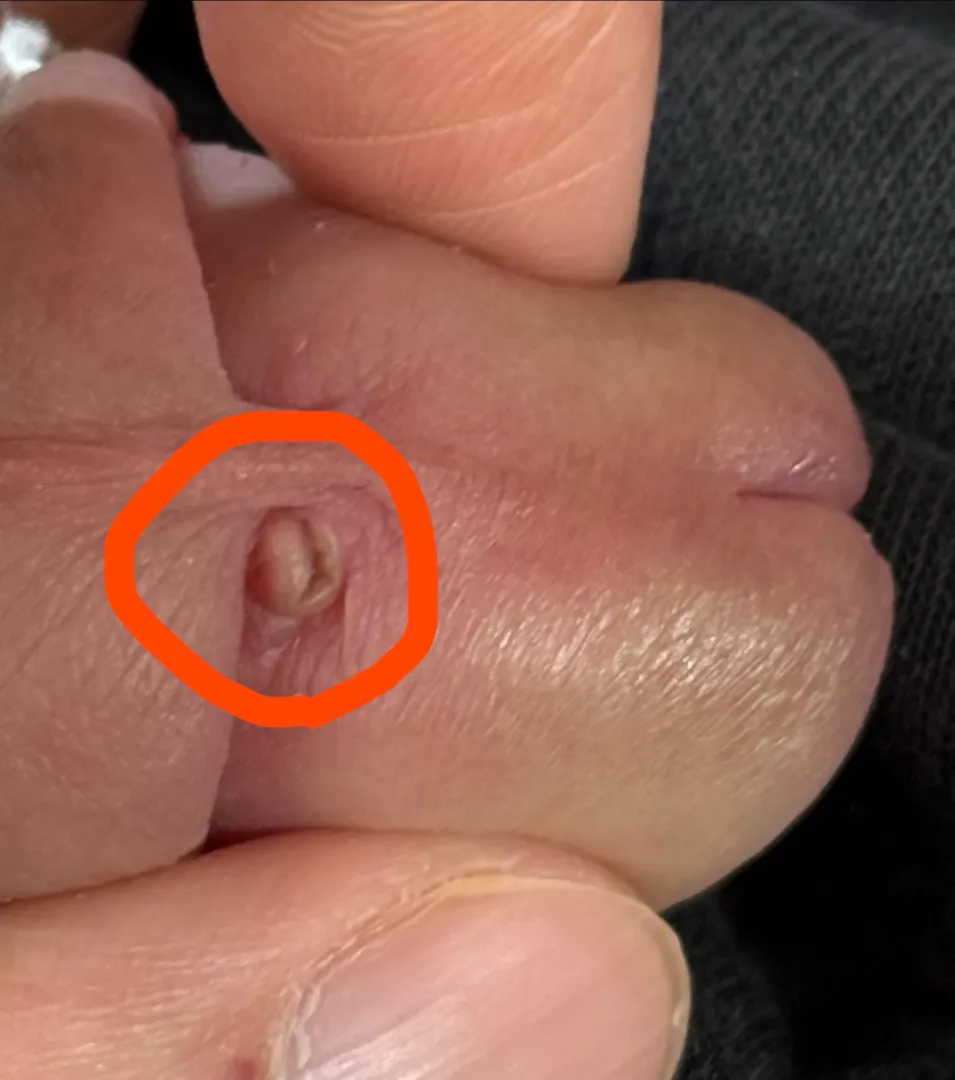 Scar tissue around PA posted by Cain_2099