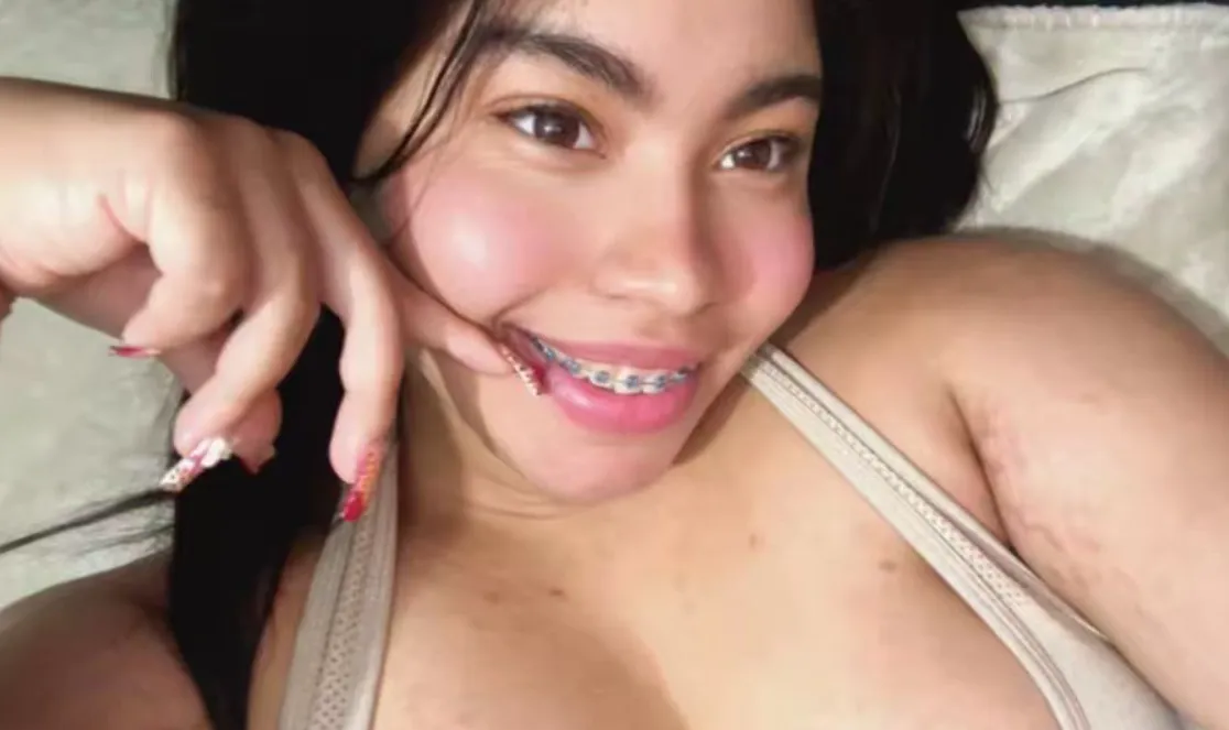 Should I get nails to match my braces? posted by Used-Professional548