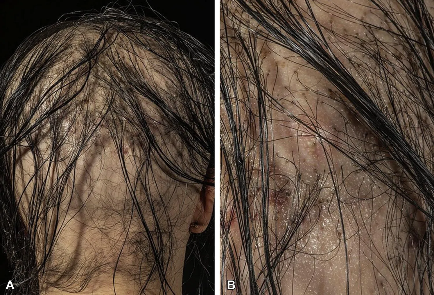 Side effects of a hair transplant attempt; a patient with alopecia got 9000 