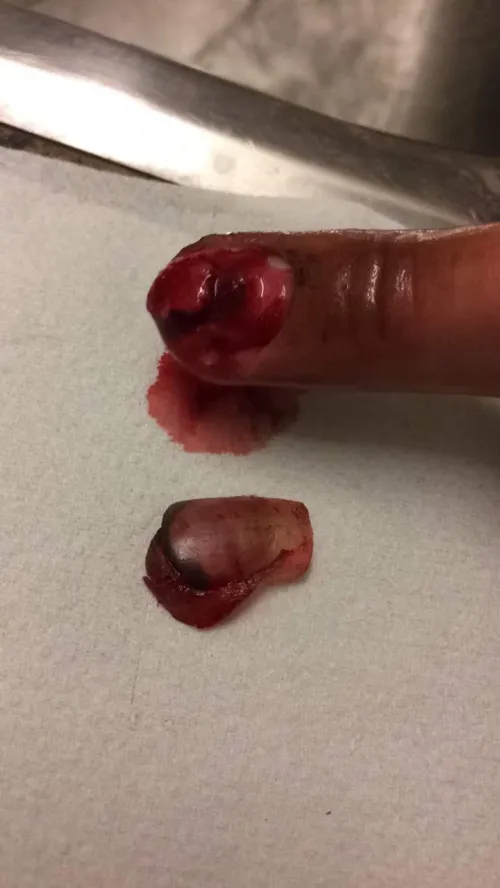 Smashed my finger while fueled with anger and energy drinks. by Dallasvdg