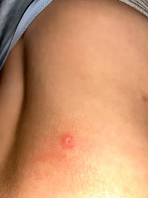Sore appeared on my back overnight, when I woke up it had a blister over it. On my lower right hand side of my back by torimalory
