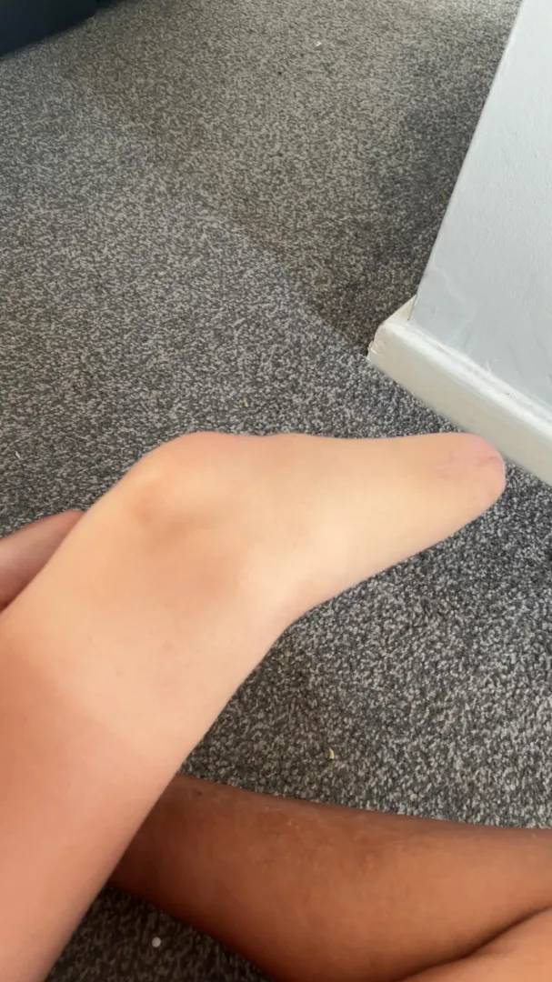 stumpys close up  posted by cuti3amput33