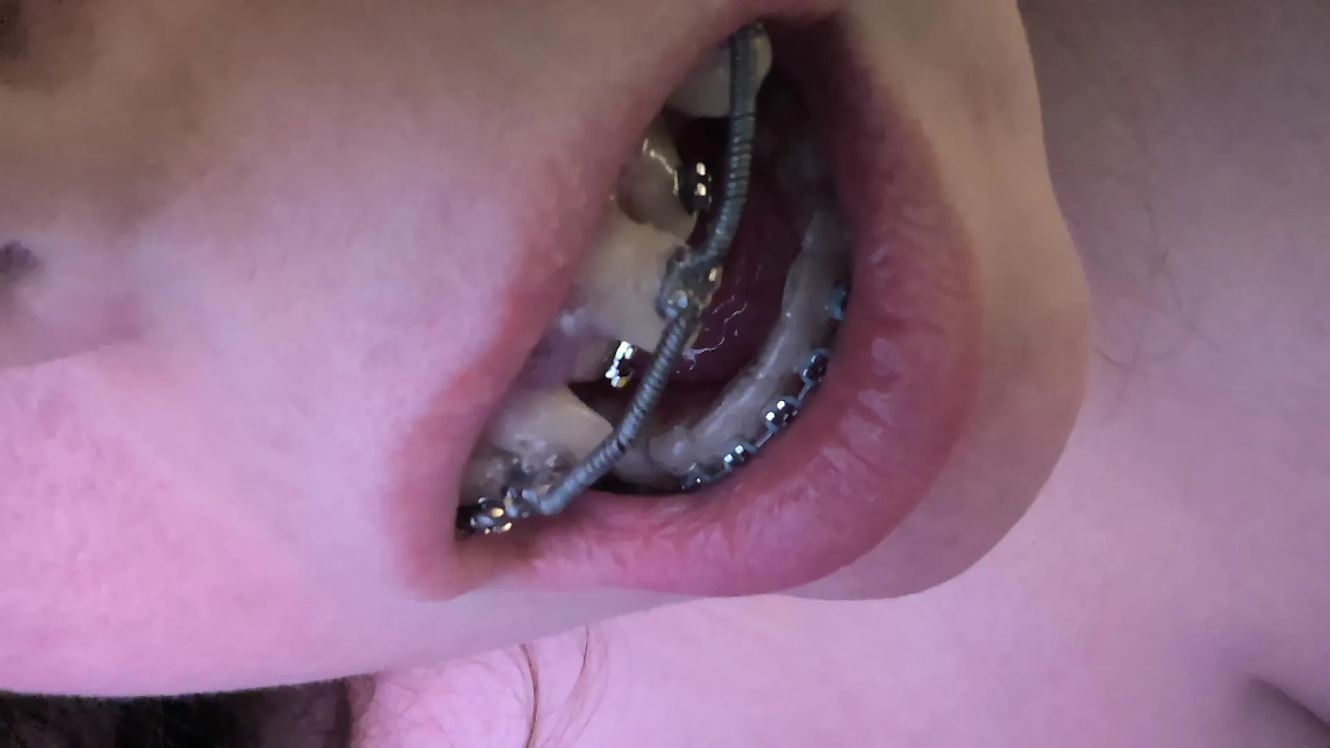 super crooked braces posted by Agile_Bag_4059