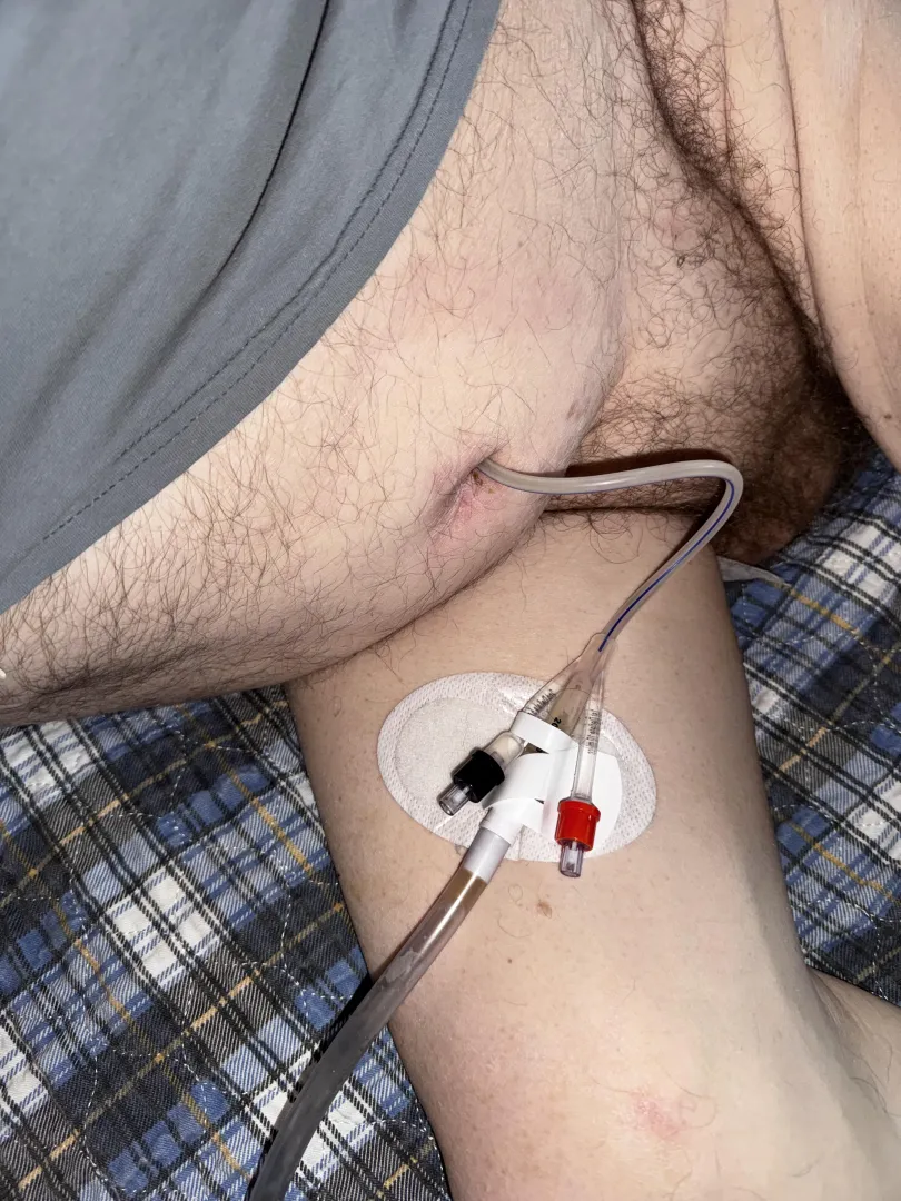 Supra public indwelling cathether, Fr 18. posted by LoveEmClassynNasty