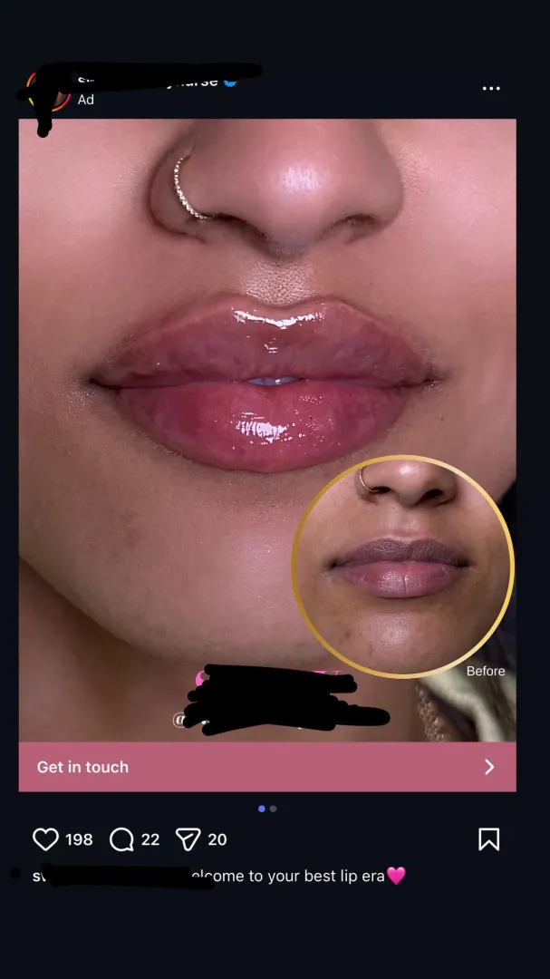 Terrible, lumpy filler advertised on IG posted by anowarakthakos