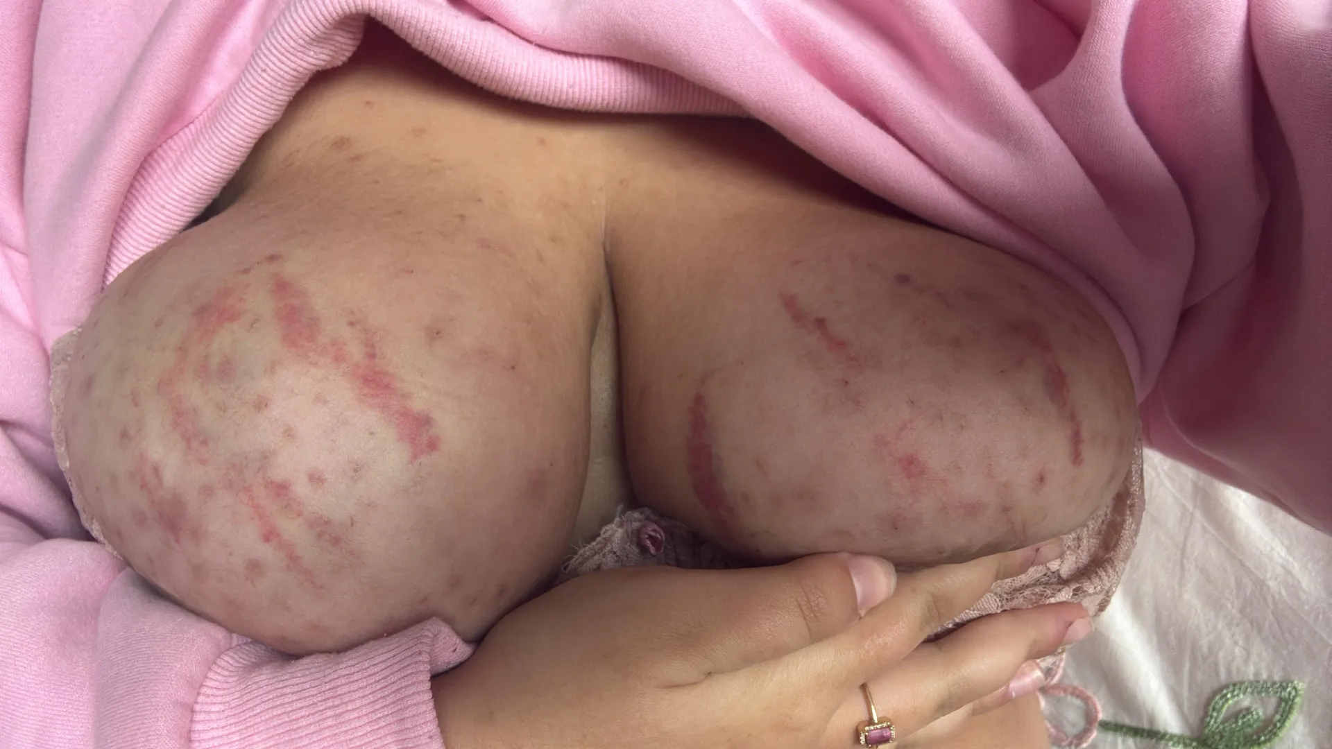 the day after snapping rubber bands on my tits posted by scw3811