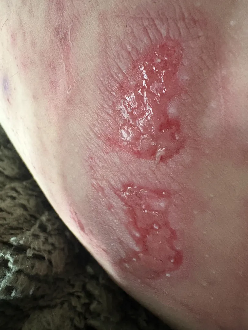 thigh chafing! (jeans became threadbare and i wore them anyway  my mistake) posted by de_moya