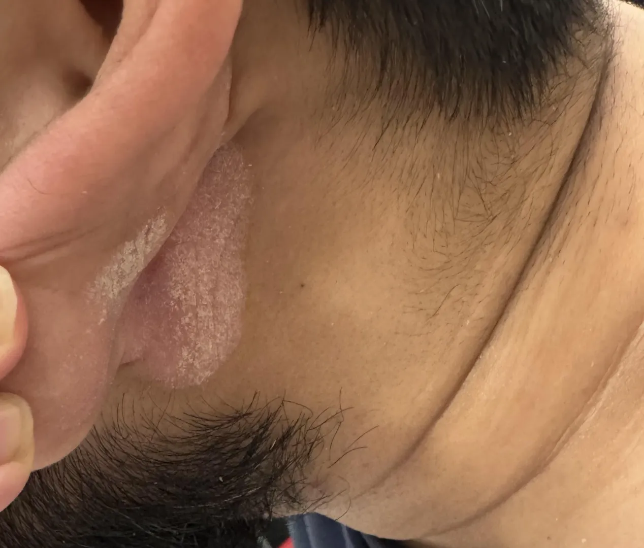 This started happening under my left ear, what is it & what ointment or medicine should I use on it to get rid of it. Thank you. posted by TheGoodDoctor17
