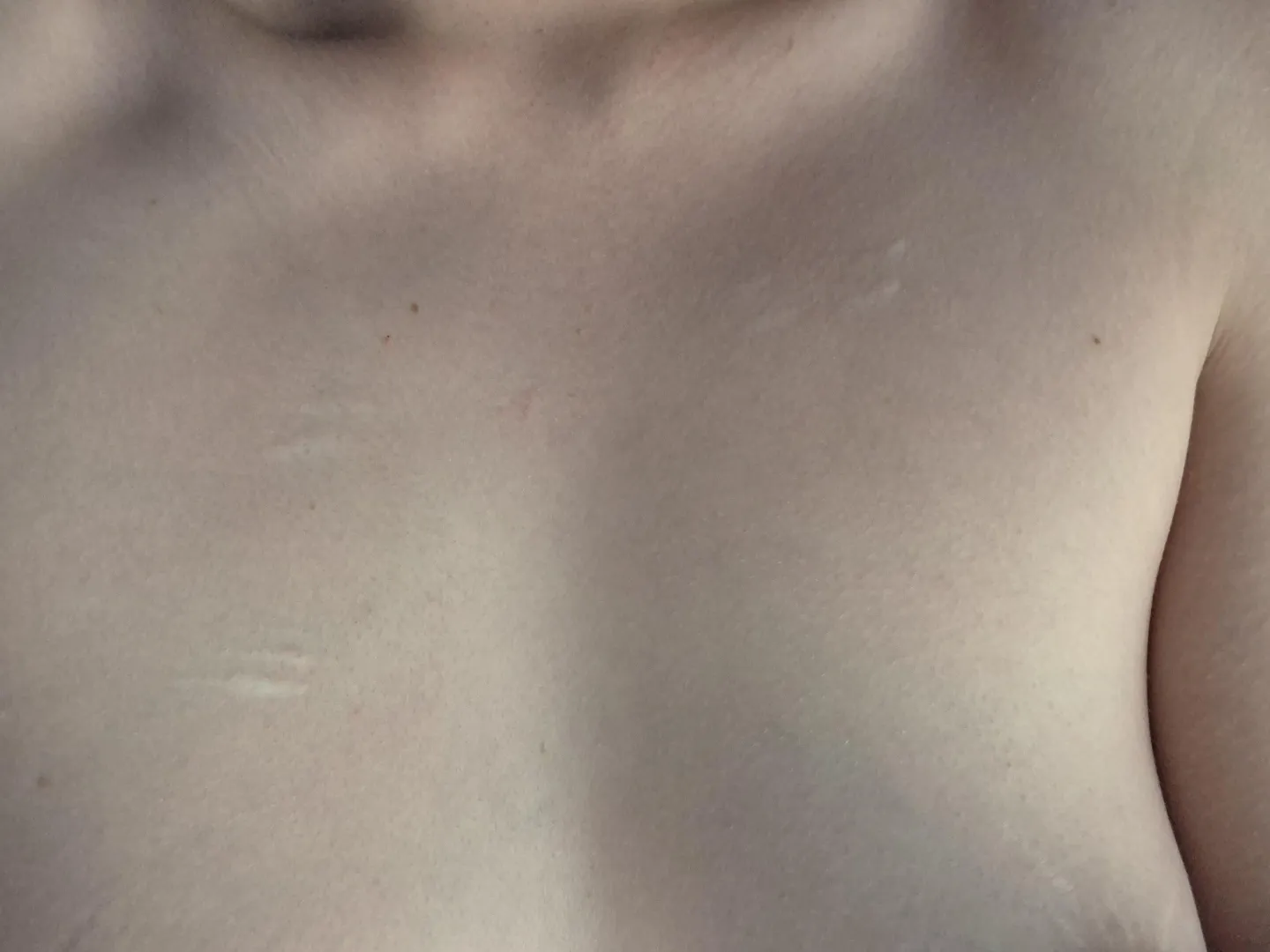 Tiny little chest scars posted by saraonly420