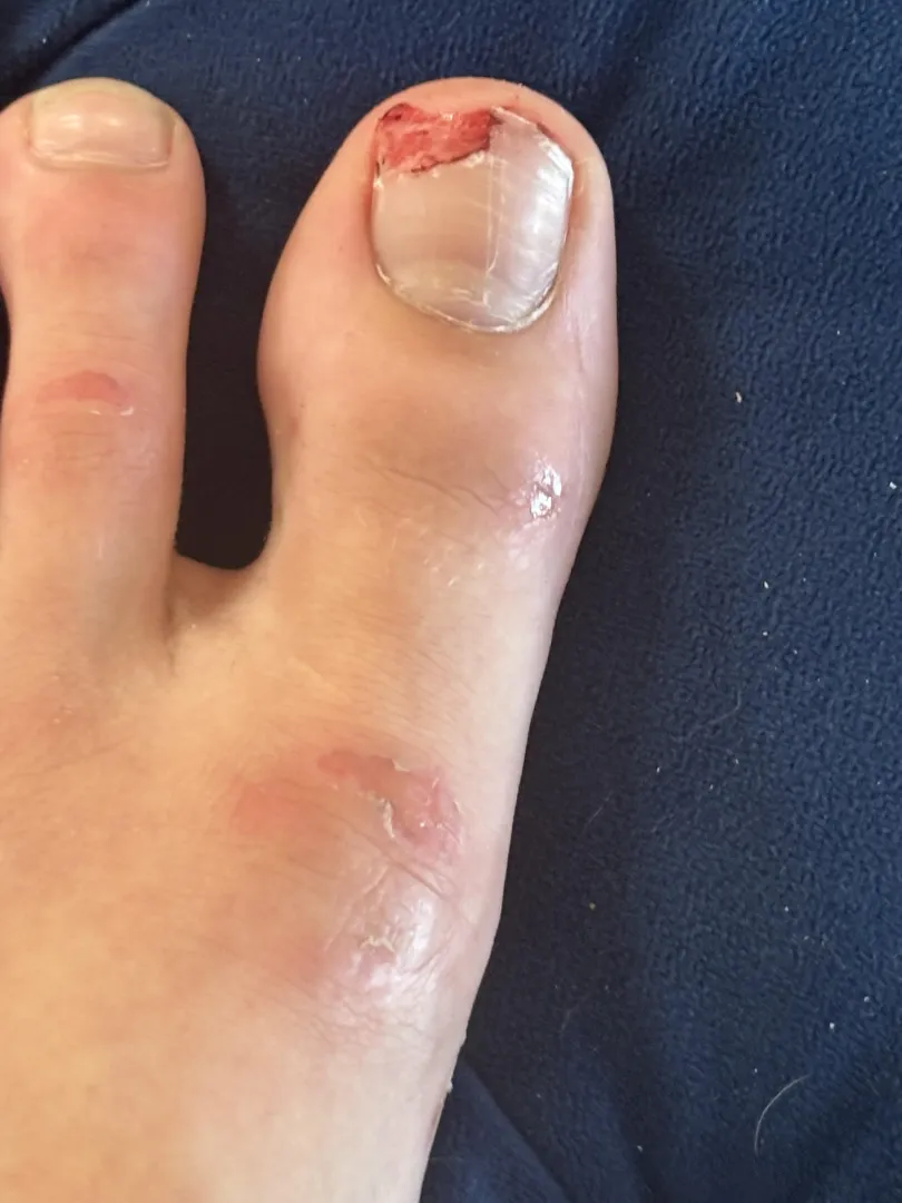 Toe posted by Melodic-Tennis-1662