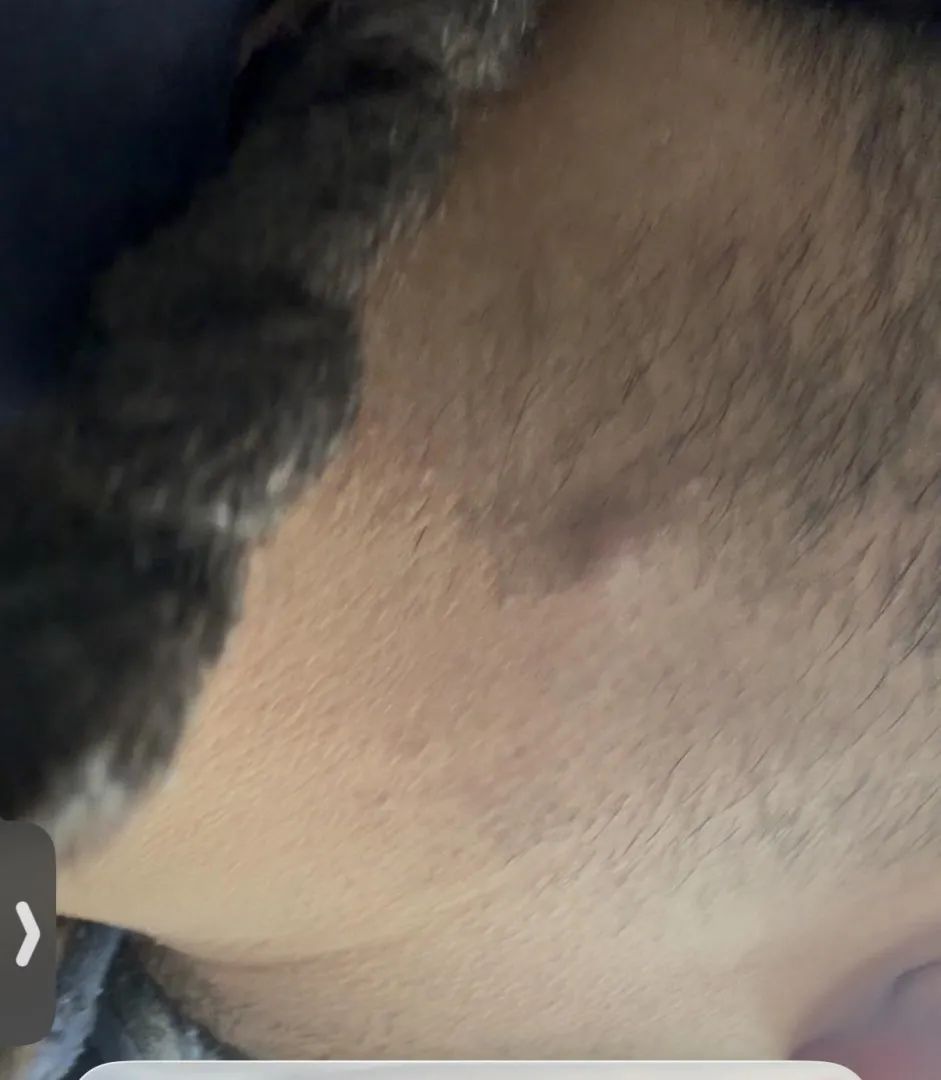 What dose this bump on the back of my neck look like. I’ve had it for a couple days posted by Waste-Discussion-633