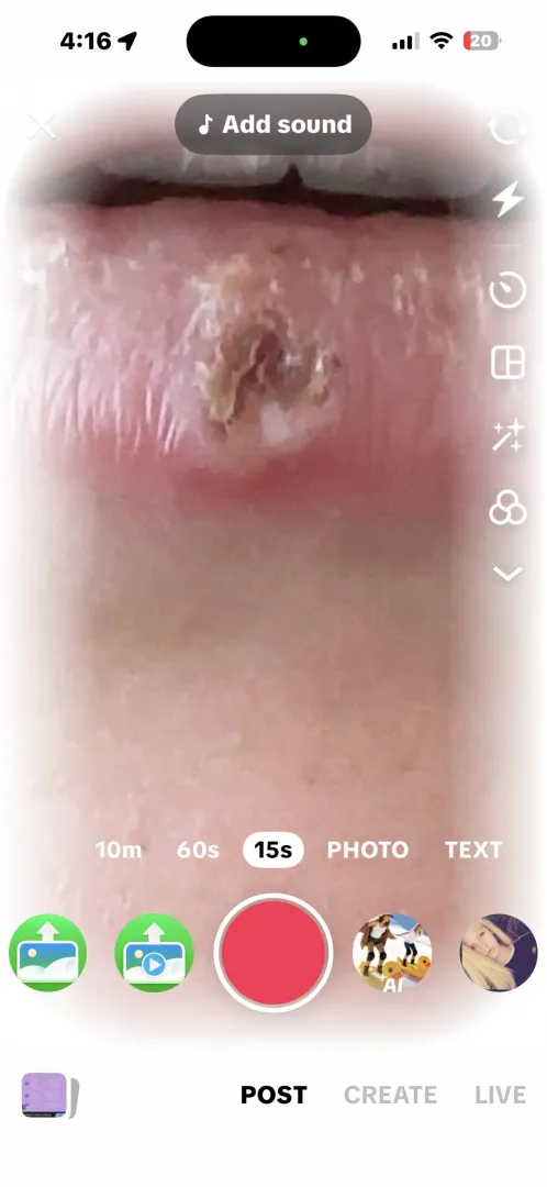 What in the world is this? Picked my lip and now have this swollen bump. posted by Vivid_Affect1446