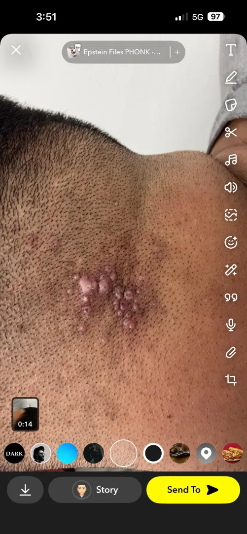 What is this? Everytime I get a haircut it happens, tried different things, nothing has helped. Bumpy pimples, getting worse. Any ideas? by pete_davidson01