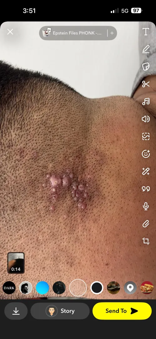 What is this? Everytime I get a haircut it happens, tried different things, nothing has helped. Bumpy pimples, getting worse. Any ideas? posted by pete_davidson01