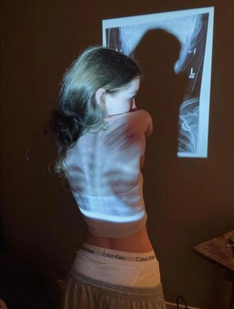 x-ray posted by Acrobatic_Edge_1803