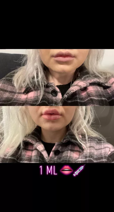 1 ml 💉 Getting those DSL lips👄 by Ikkefantadrikker