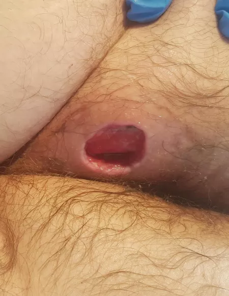 1 week after surgery on my abscess by RevalationsZ993