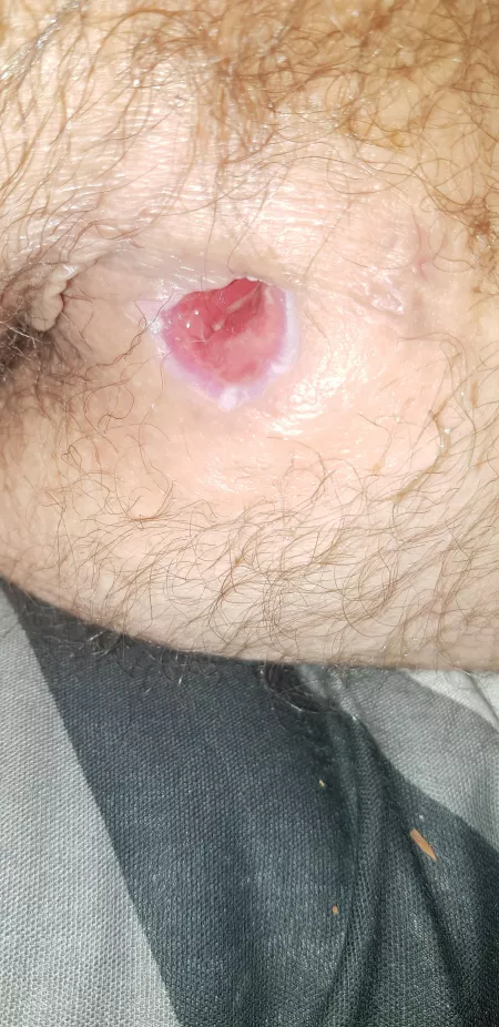 2 weel after surgery on my abscess and its healing great (thats wot im told) by RevalationsZ993