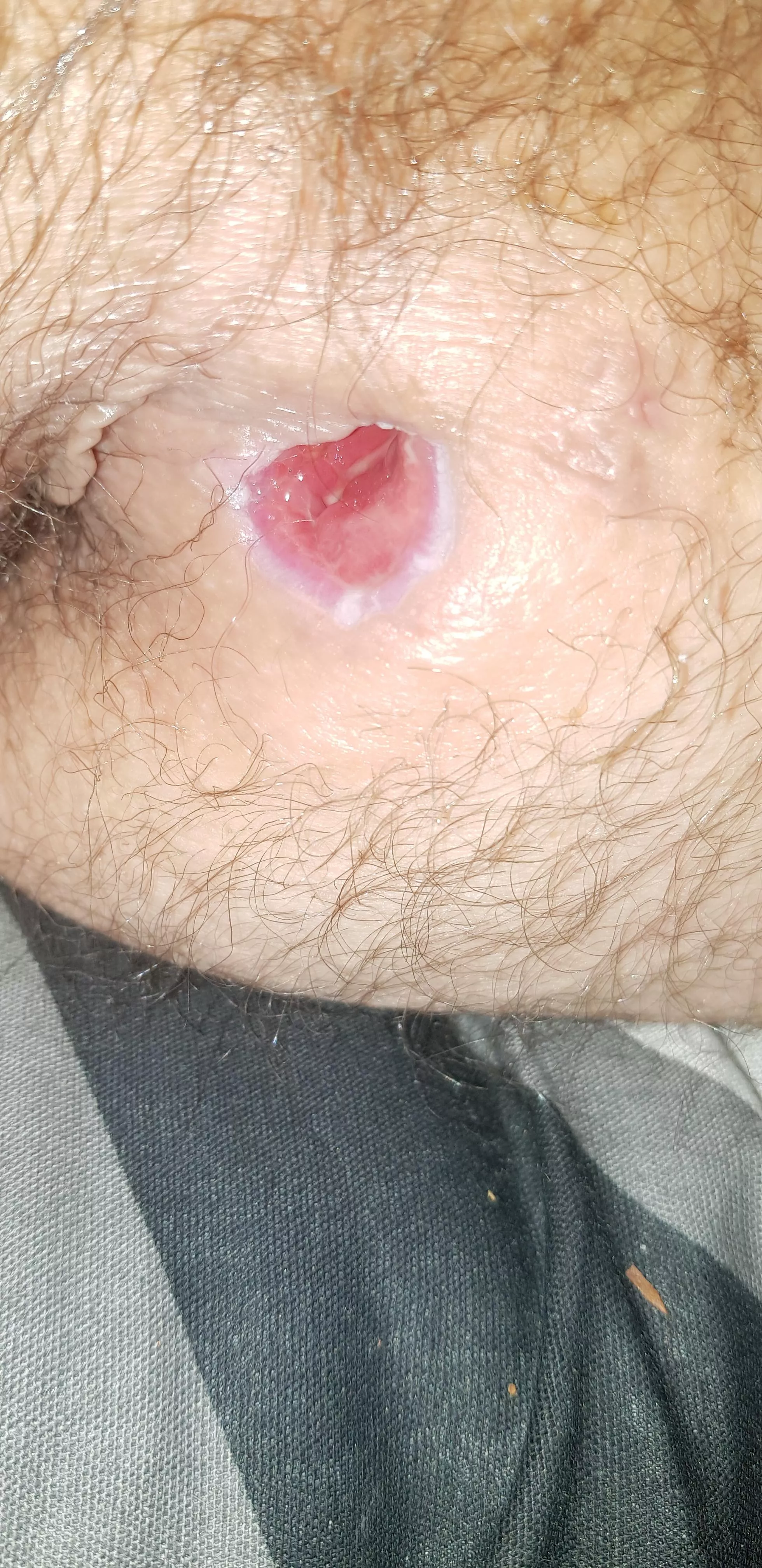 2 weel after surgery on my abscess and its healing great (thats wot im told) posted by RevalationsZ993