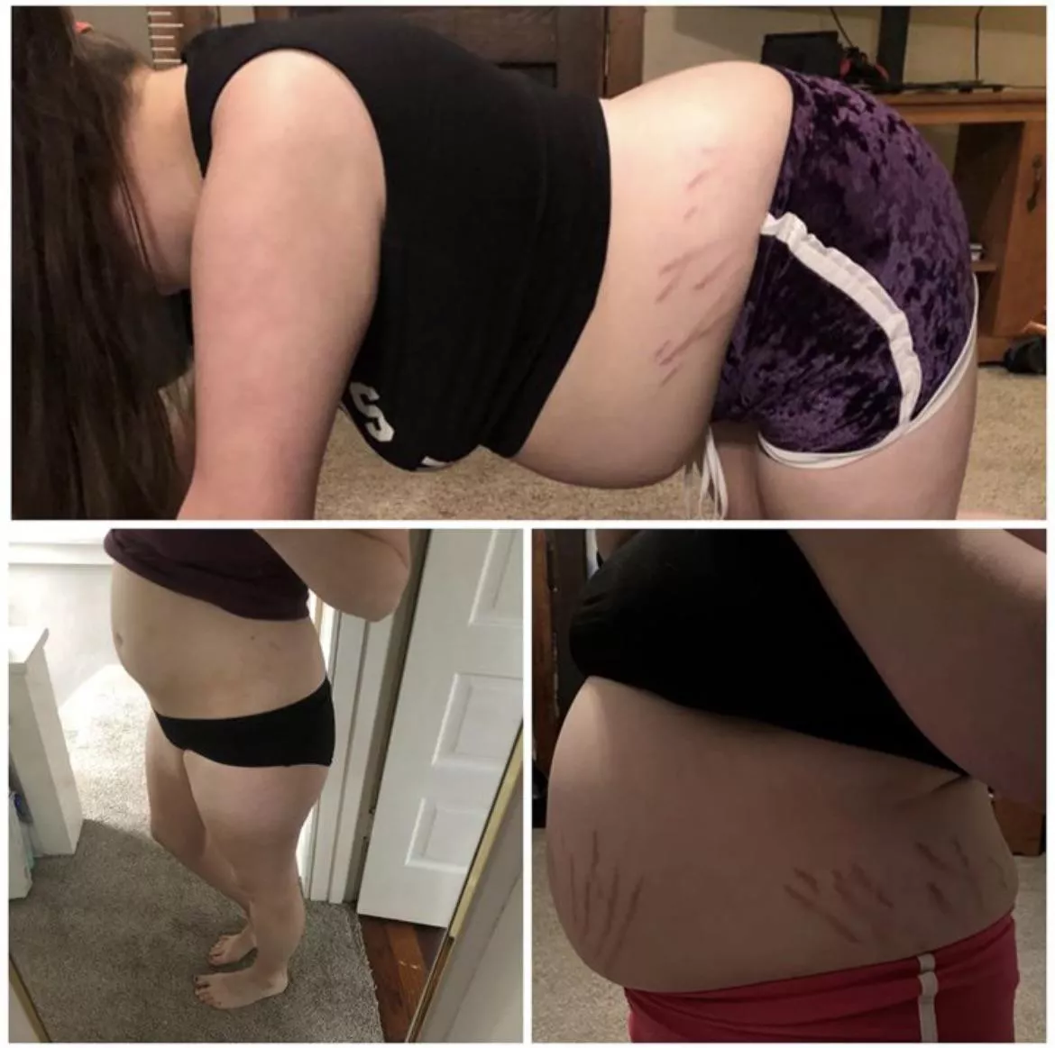 2 years ago when I was around 170 to around 220 in these photos! So many new stretch marks! posted by Chipmunk3333