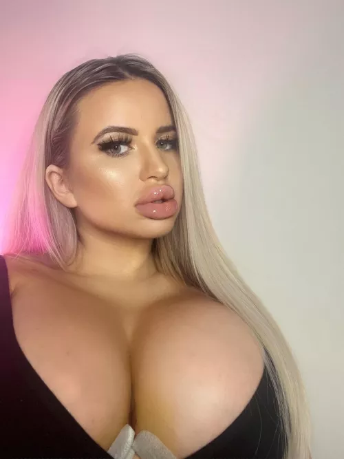 7 Days post surgery 🥰 instead of 1700cc, the doctor was able to fill them until 2000cc per side 🥰🥰🥰 by Relevant-Party1420