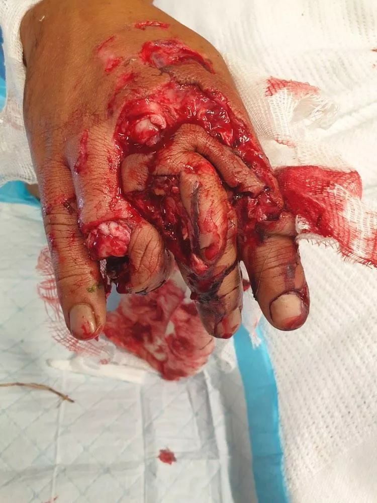 A friend of mine got his hand caught in some farm machinery. posted by CannasseurB