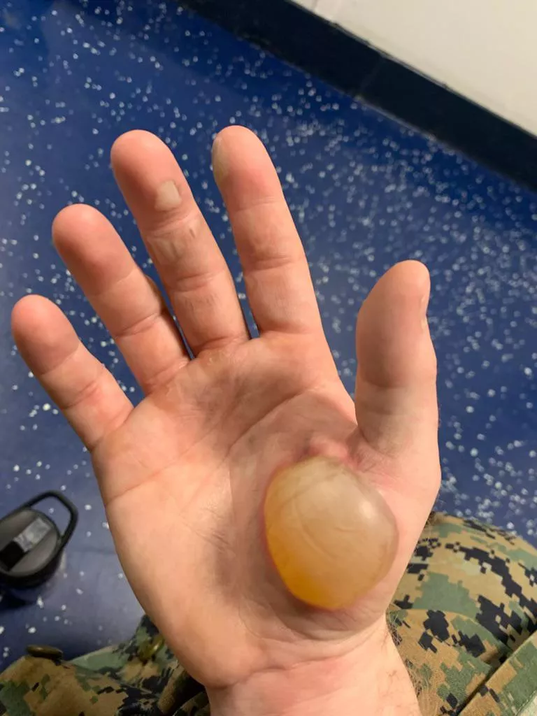 A most forbidden pop (cared for by surgeon, healed now) posted by FckboyFC