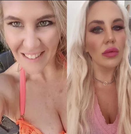 A year ago to now. Lips getting there just need boobs done 2200cc the goal! by leftat11