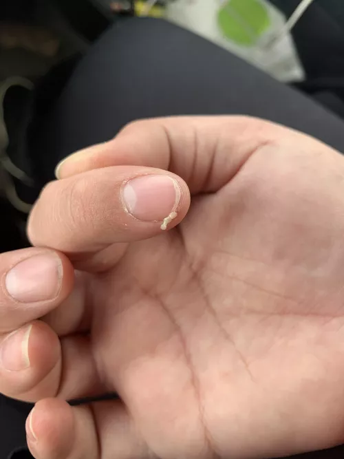 Aftermath of face pimple by iusestolivein